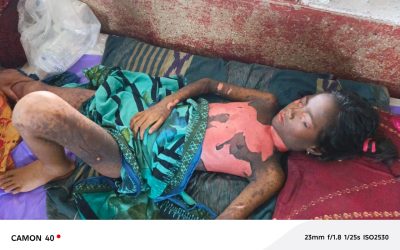 হাতুড়ে পল্লী চিকিৎসকের ভুল চিকিৎসায় সারা শরীরে ক্ষত নিয়ে হাসপাতালে কাতরাচ্ছে শিশু নুরজাহান