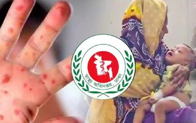 এবার ২৪ ঘন্টায় হাম ও উপসর্গ নিয়ে মৃত্যুর রেকর্ড