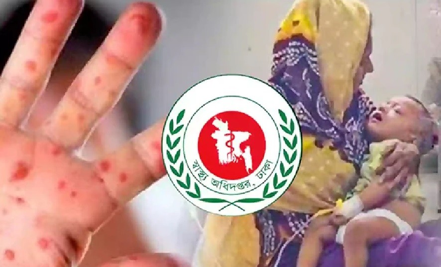 এবার ২৪ ঘন্টায় হাম ও উপসর্গ নিয়ে মৃত্যুর রেকর্ড